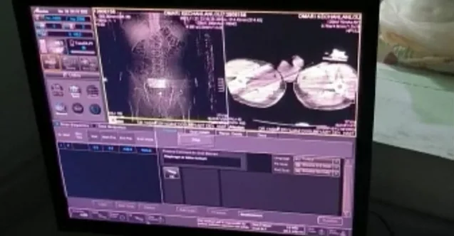 Ağrı’da Midesinde Uyuşturucu Taşıyan 4 Kişi Yakalandı